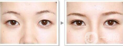 高分子埋線是*的嗎？可以維持幾年？