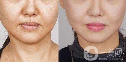 面部提升,價(jià)格