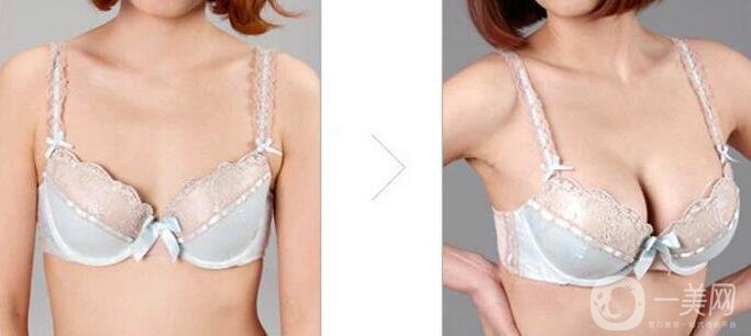 水滴型假體隆胸怎么樣？隆胸風險高嗎？