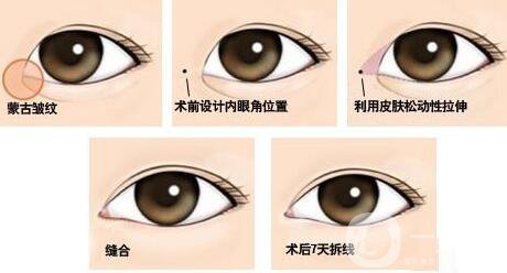 開(kāi)眼角*果有哪些、開(kāi)眼角手術(shù)的*果怎么樣？