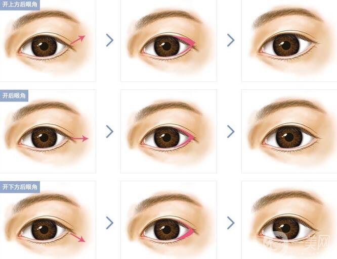 開(kāi)眼角*果有哪些、開(kāi)眼角手術(shù)的*果怎么樣？