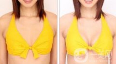 曼托假體隆胸手術有風險嗎？曼托假體隆胸后遺癥介紹