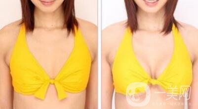 曼托假體隆胸手術(shù)有風(fēng)險嗎？曼托假體隆胸后遺癥介紹