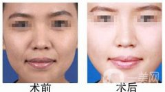 自體脂肪豐鼻唇溝有什么優(yōu)勢？果怎么樣呢？