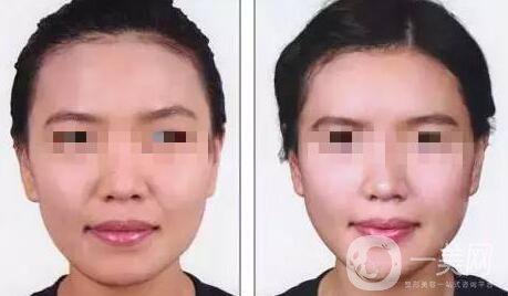 自體脂肪豐鼻唇溝有什么優(yōu)勢(shì)？*果怎么樣呢？