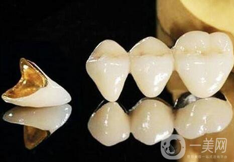 黃金烤瓷牙多少錢一顆？黃金烤瓷牙價格詳解