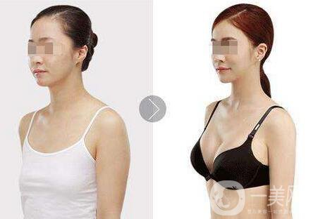 隆胸曼托假體多少錢？曼托假體價格詳解