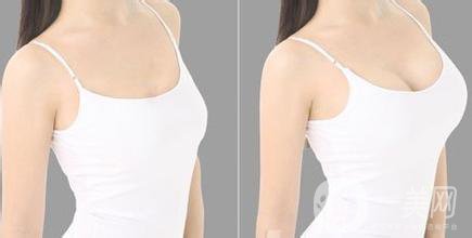 曼托假體豐胸價格大概多少錢？