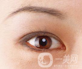 生物焊接雙眼皮是什么？有什么特點？