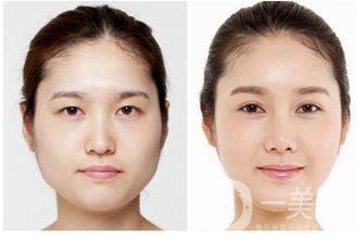 生物焊接雙眼皮是什么？有什么特點？