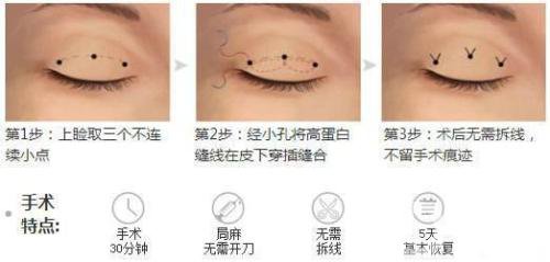 三點式雙眼皮*果一般能撐幾年？