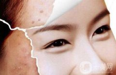 光子嫩膚能去痘印嗎、光子嫩膚去痘印果怎么樣？