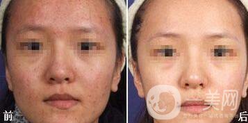 光子嫩膚能去痘印嗎、光子嫩膚去痘印*果怎么樣？