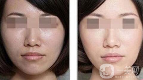 光子嫩膚做一次多少錢、光子嫩膚價(jià)格詳解