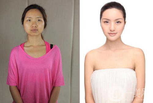 光子嫩膚有些什么*果和好處？