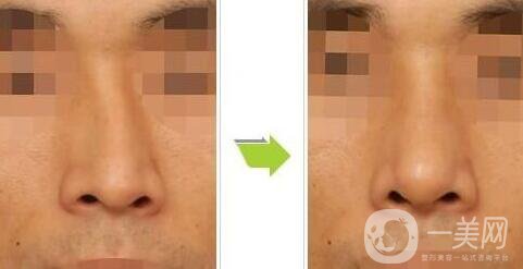 歪鼻矯正需要多少錢、歪鼻矯正術(shù)的價(jià)格詳解