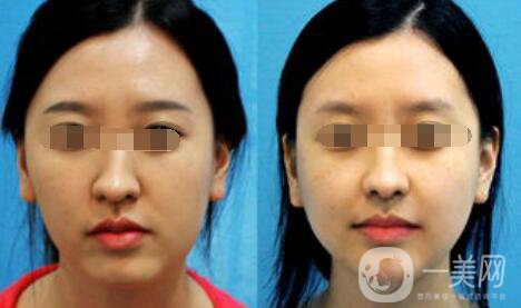 歪鼻矯正需要多少錢、歪鼻矯正術(shù)的價(jià)格詳解