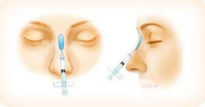 上海注射隆鼻要多少錢？注射隆鼻價錢詳解