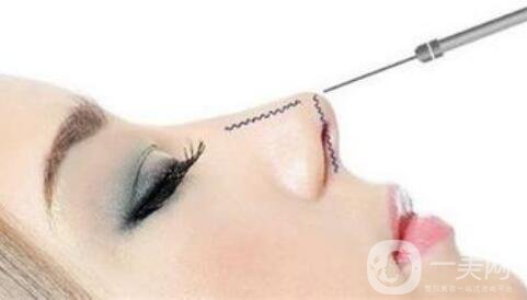 上海注射隆鼻要多少錢？注射隆鼻價錢詳解