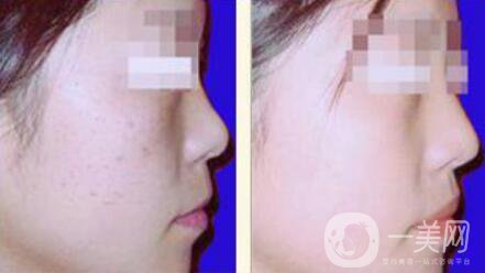 光子嫩膚的*果如何、光子嫩膚到底怎么樣？