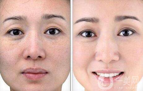 微針美容,費(fèi)用