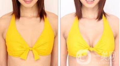 妙桃,假體隆胸,多少錢