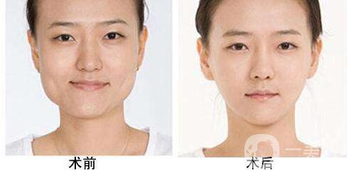 削骨,多少錢,價(jià)格