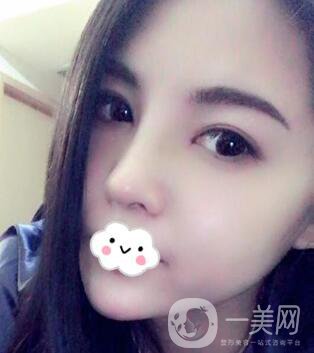 *隆鼻價格 *隆鼻需要多少錢