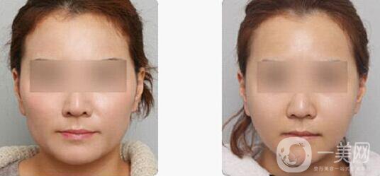 改臉型多少錢？ 改臉型需要多少錢？