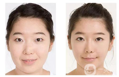 注射*的注意事項(xiàng)有些什么？