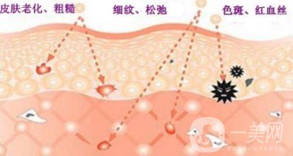 做光子嫩膚有什么作用和好處？