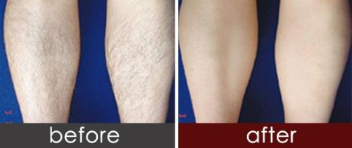 做激光脫毛價格大概是多少？