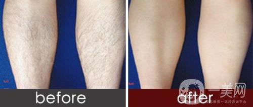 做激光脫毛價格大概是多少？