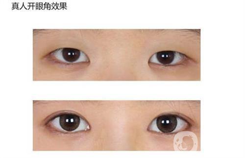 做開眼角手術需要多少錢？