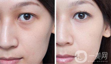 注射伊維蘭玻尿酸除皺多少錢？