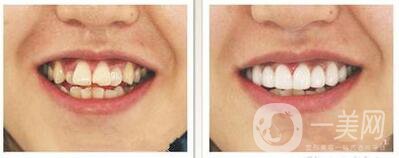 烤瓷牙的種類及價(jià)錢介紹、前后照片分享