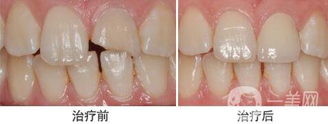 裝個烤瓷牙多少錢？烤瓷牙詳細(xì)價格介紹