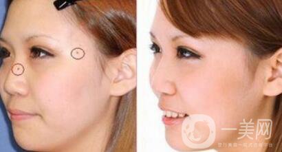 激光點痣大概多少錢？激光祛痣的價格詳解