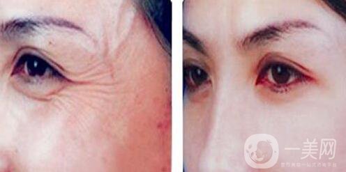 去皺多少錢(qián)？除皺價(jià)格詳細(xì)介紹