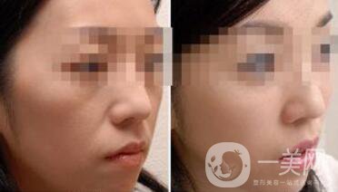 去皺多少錢(qián)？除皺價(jià)格詳細(xì)介紹