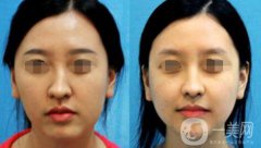 歪鼻矯正需要多少錢？上海歪鼻矯正價(jià)格詳解