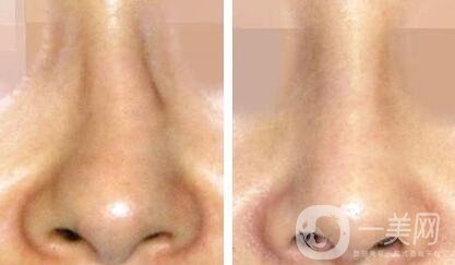 歪鼻矯正需要多少錢(qián)？上海歪鼻矯正價(jià)格詳解