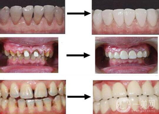 烤瓷牙的材料有哪些？烤瓷牙*果如何