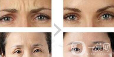 眉間皺紋如何去除？眉間川字紋怎么才能去掉