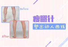 注射瘦腿會反彈嗎 注射瘦腿果維持多久