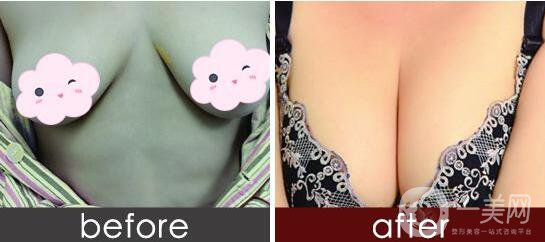 妙桃隆胸,費(fèi)用