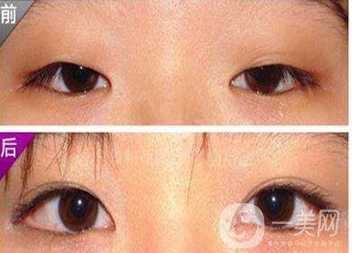 開眼角手術(shù),價(jià)格