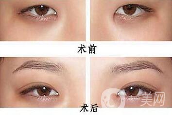 韓式開眼角哪*果好？哪個(gè)醫(yī)院做韓式開眼角比較好