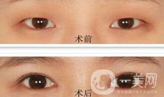 韓式開眼角哪*果好？哪個(gè)醫(yī)院做韓式開眼角比較好