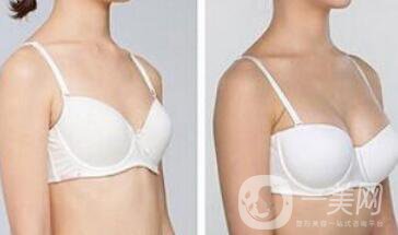 曼托假體豐胸要多少錢？曼托假體豐胸費(fèi)用詳解
